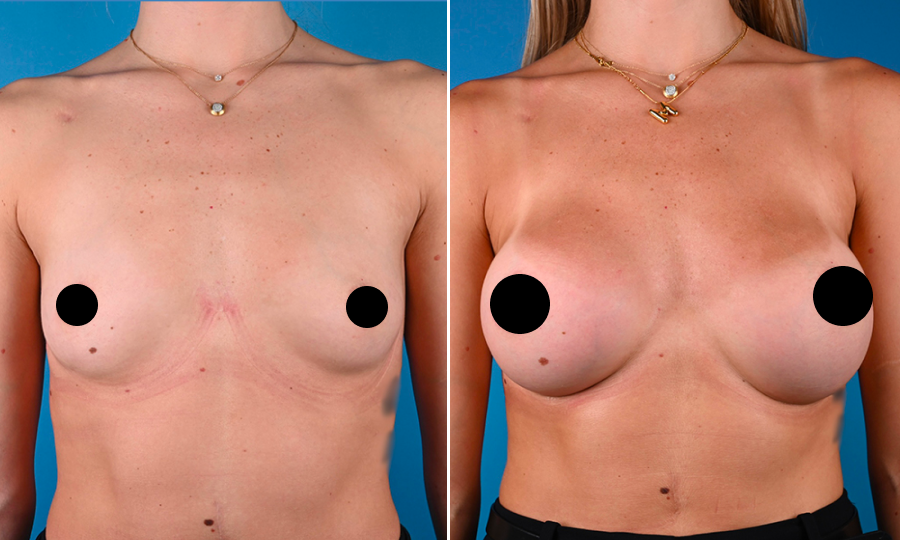 Before-and-after-1-Breast-Aug.png