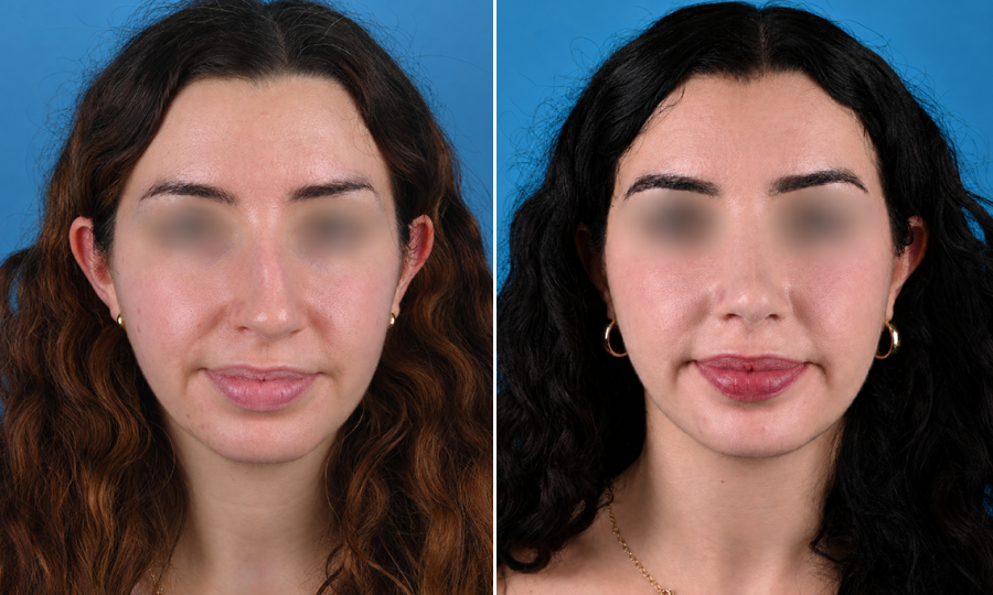 Before-and-after-1-Rhinoplasty.png