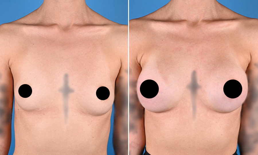 Before-and-after-10-Breast-Aug.png