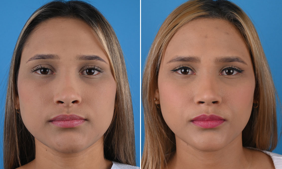 Before-and-after-10-Rhinoplasty.png
