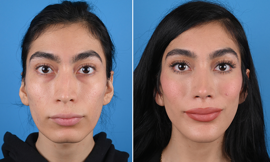 Before-and-after-11-Rhinoplasty.png