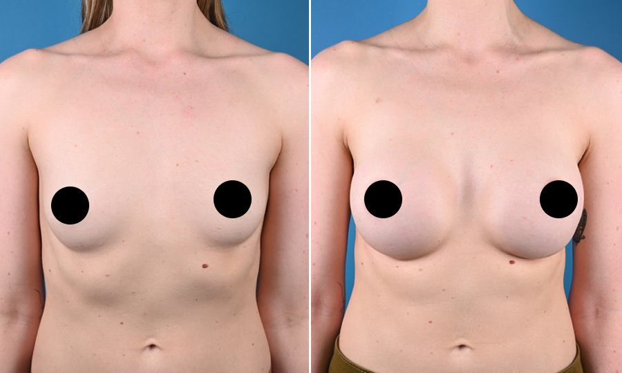 Before-and-after-2-Breast-Aug.png