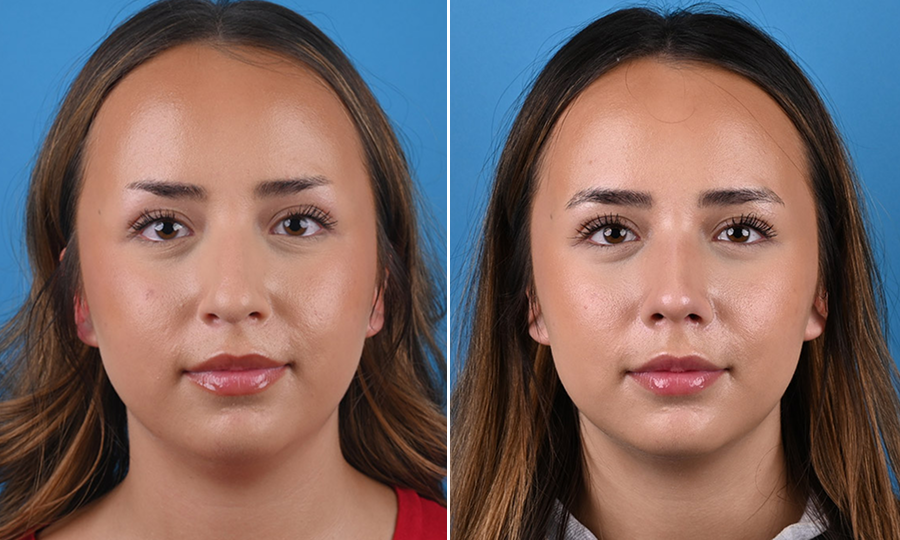 Before-and-after-2-Rhinoplasty.png