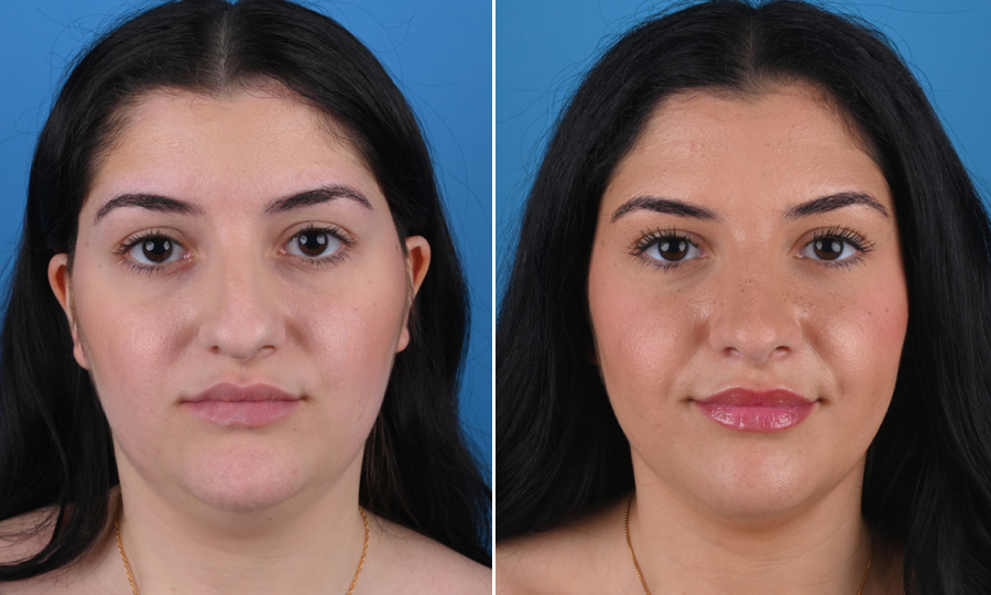 Before-and-after-3-Rhinoplasty.png