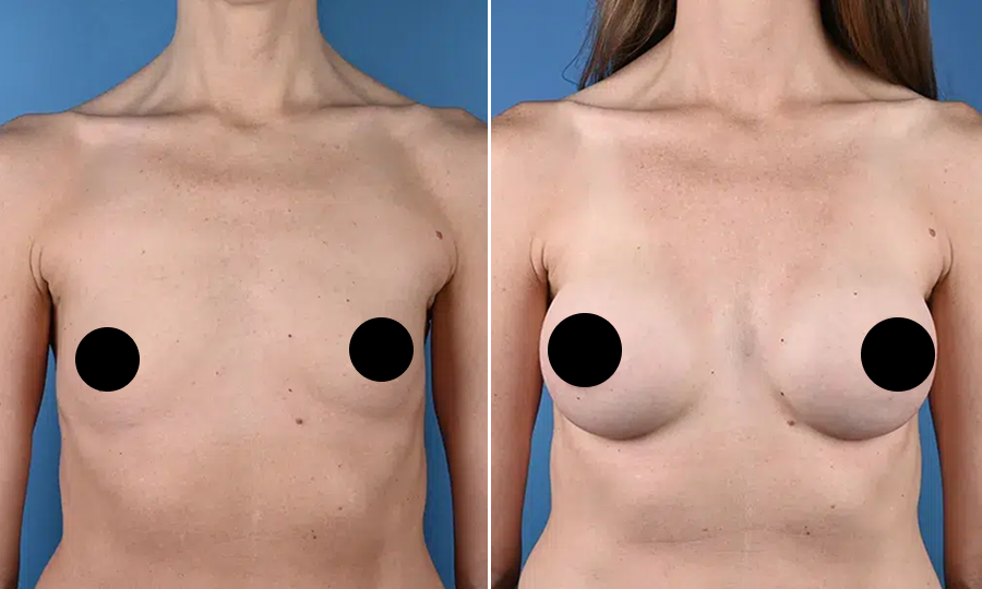 Before-and-after-4-Breast-Aug.png