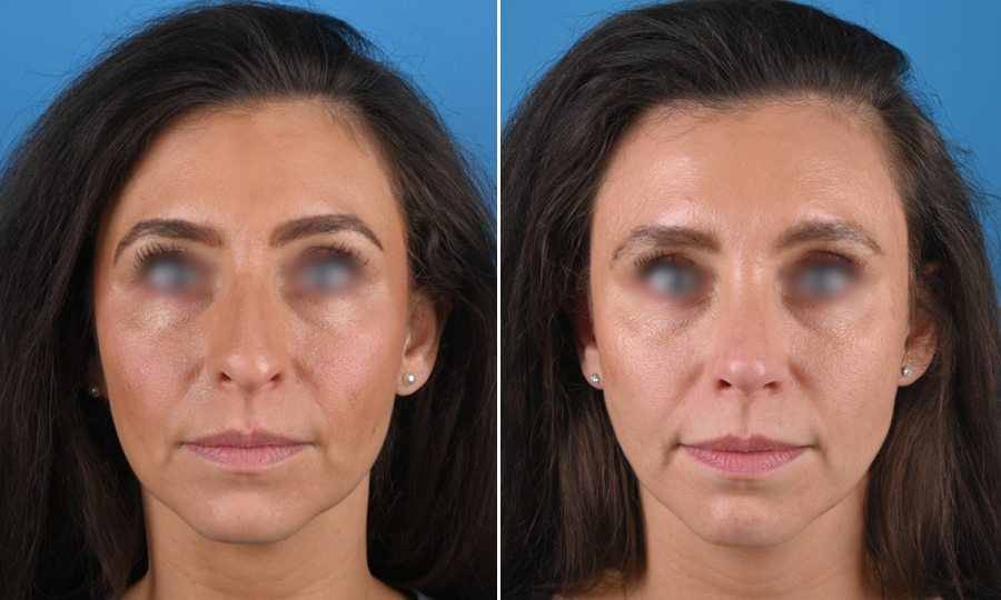 Before-and-after-4-Rhinoplasty.png