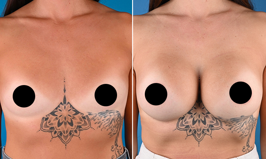 Before-and-after-5-Breast-Aug.png