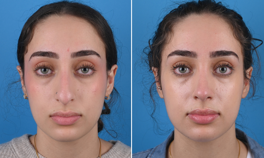 Before-and-after-5-Rhinoplasty.png