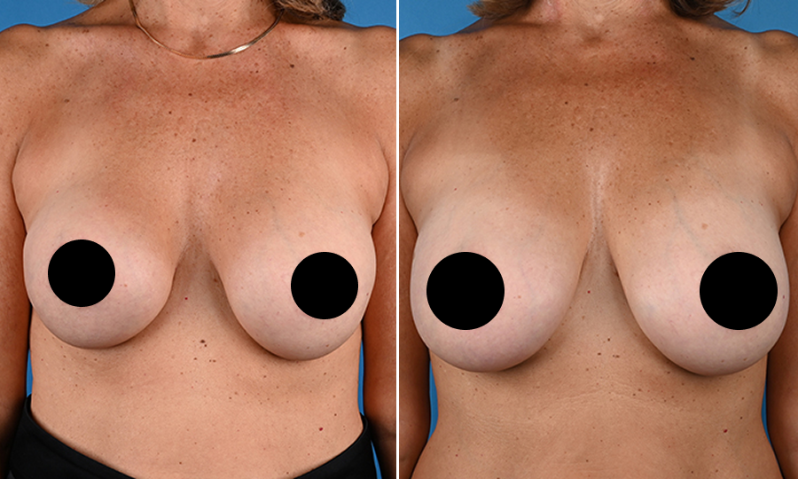 Before-and-after-6-Breast-Aug.png