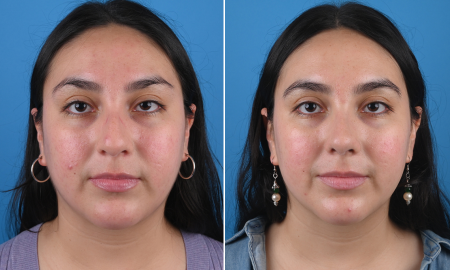 Before-and-after-6-Rhinoplasty.png
