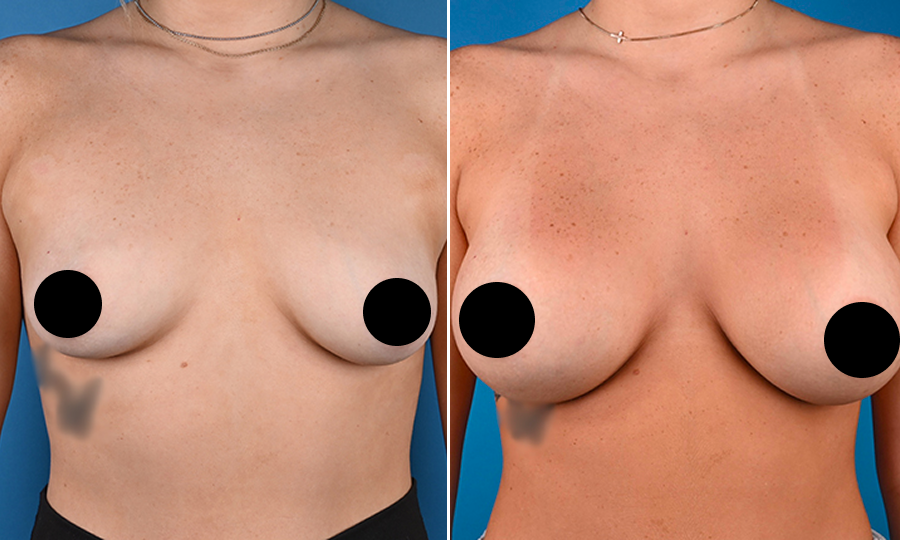 Before-and-after-7-Breast-Aug.png