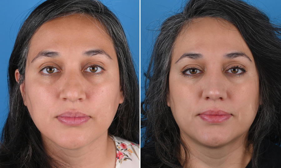 Before-and-after-7-Rhinoplasty.png