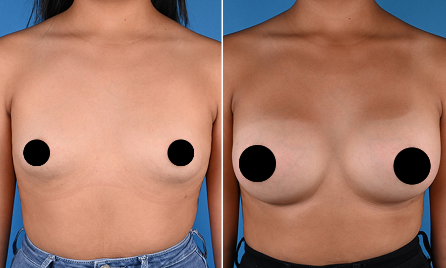 Before-and-after-8-Breast-Aug.png