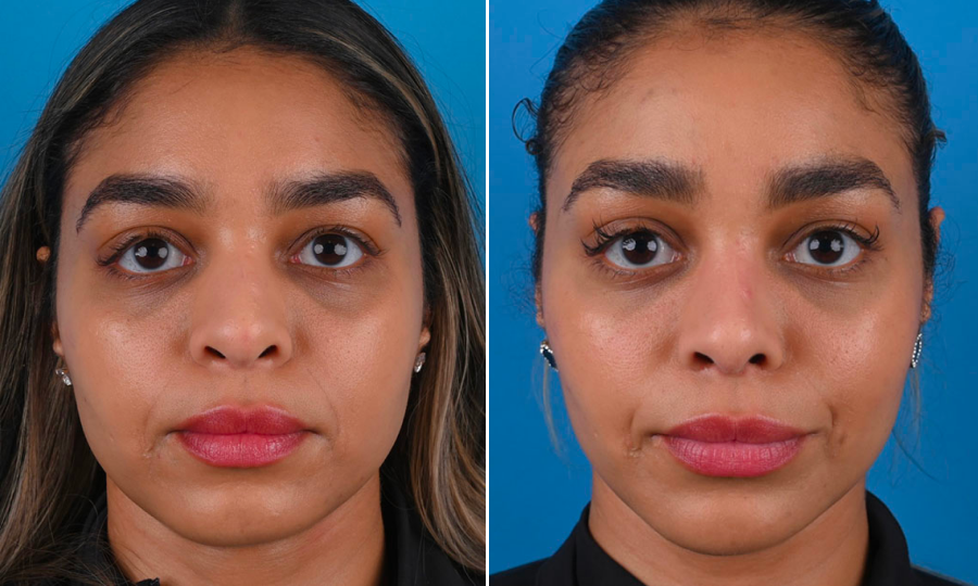 Before-and-after-8-Rhinoplasty.png