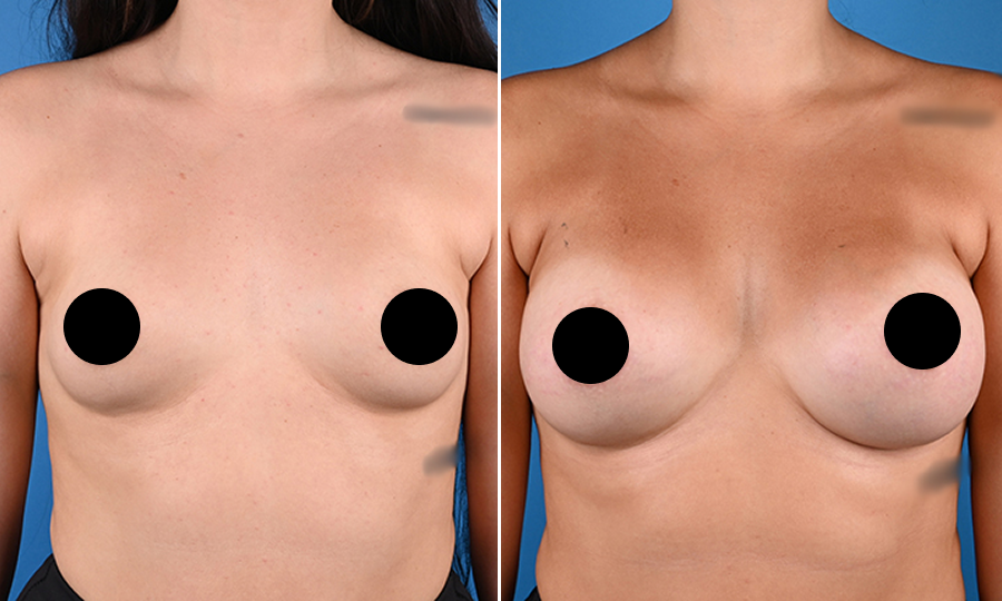 Before-and-after-9-Breast-Aug.png