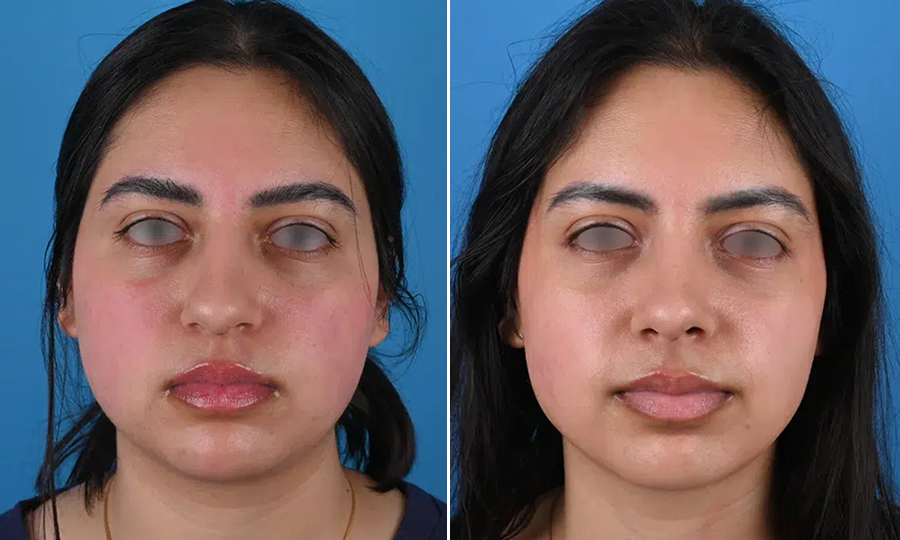 Before-and-after-9-Rhinoplasty.png